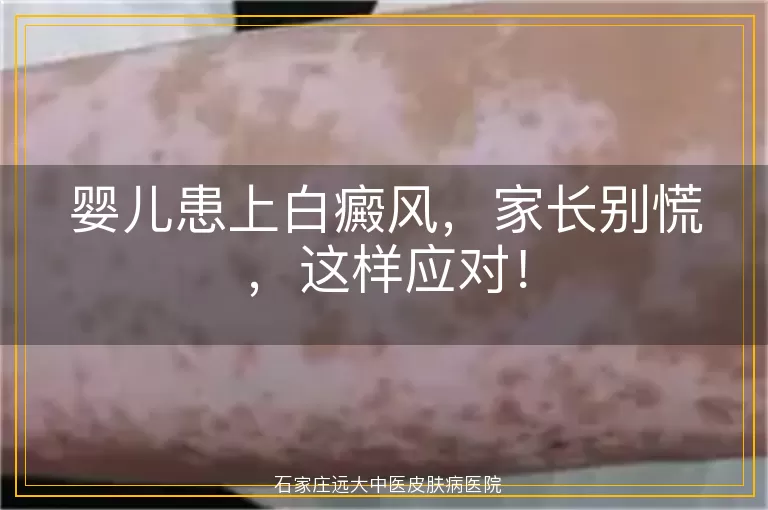 婴儿患上白癜风，家长别慌，这样应对！