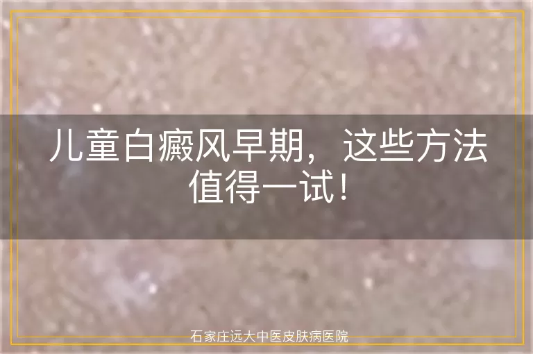 儿童白癜风早期，这些方法值得一试！