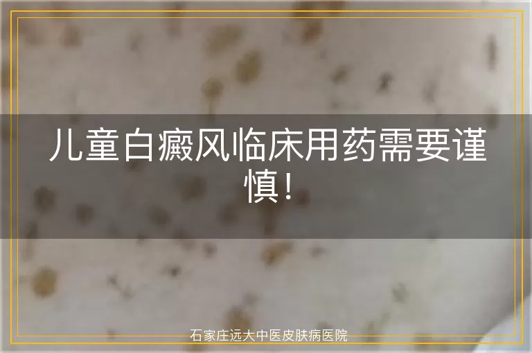 儿童白癜风临床用药需要谨慎！