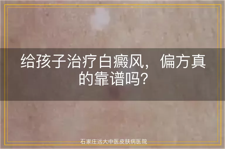 给孩子治疗白癜风，偏方真的靠谱吗？
