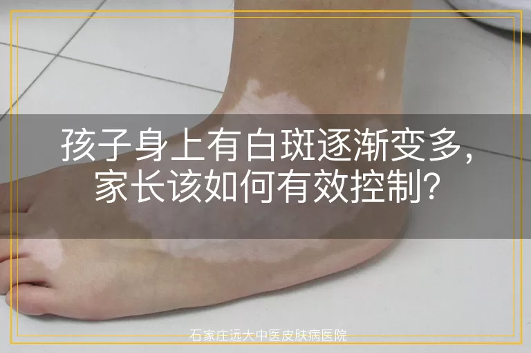 孩子身上有白斑逐渐变多，家长该如何有效控制？