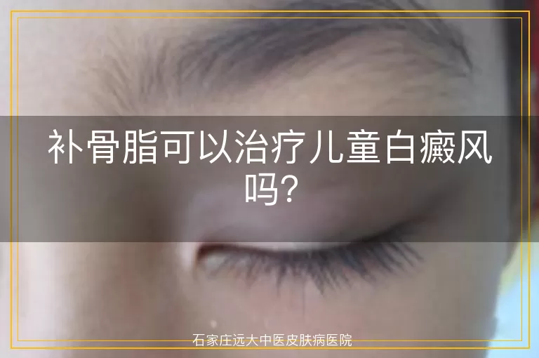 补骨脂可以治疗儿童白癜风吗？
