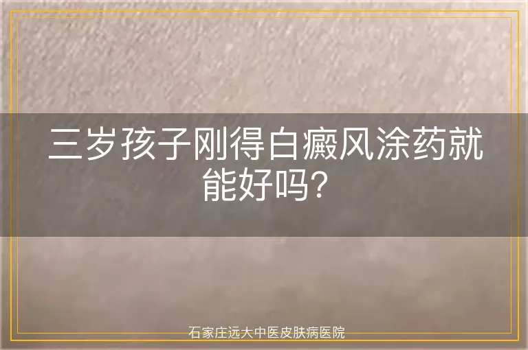 三岁孩子刚得白癜风涂药就能好吗?