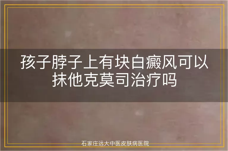 孩子脖子上有块白癜风可以抹他克莫司治疗吗