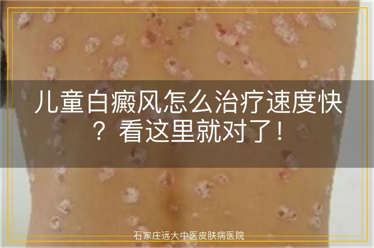 儿童白癜风怎么治疗速度快？看这里就对了！