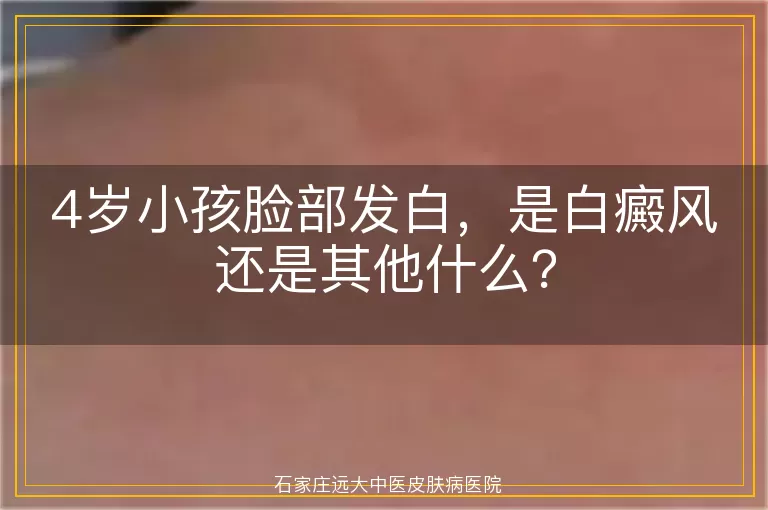 4岁小孩脸部发白，是白癜风还是其他什么？
