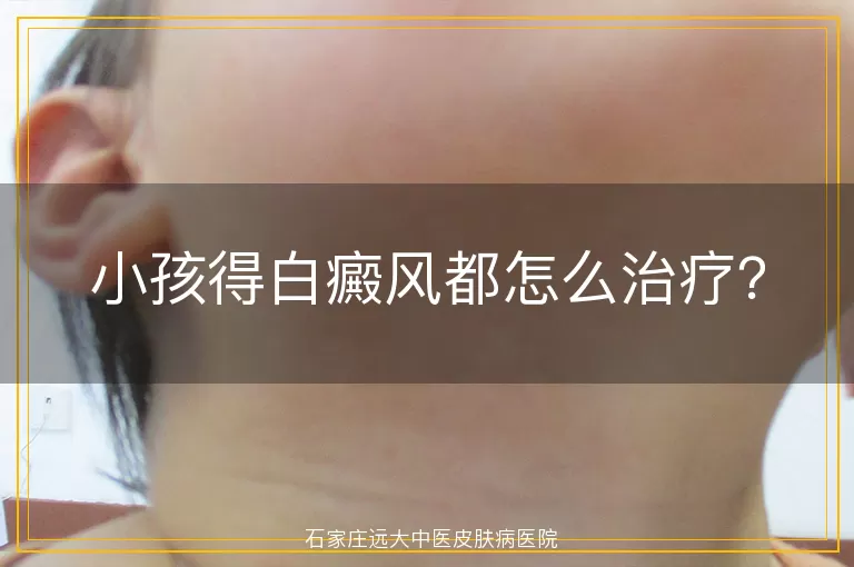 小孩得白癜风都怎么治疗？