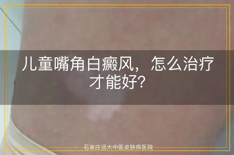 儿童嘴角白癜风，怎么治疗才能好？