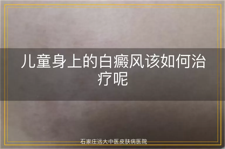 儿童身上的白癜风该如何治疗呢