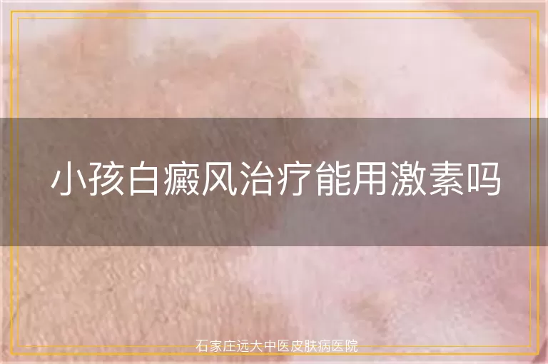 小孩白癜风治疗能用激素吗