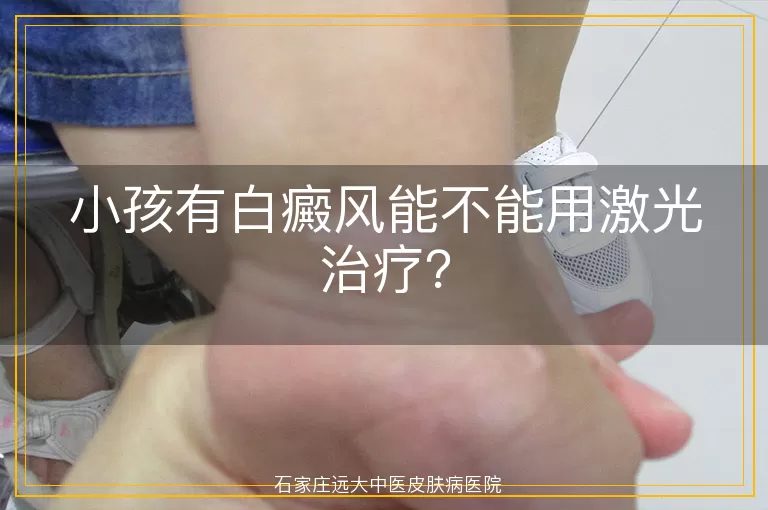 小孩有白癜风能不能用激光治疗？