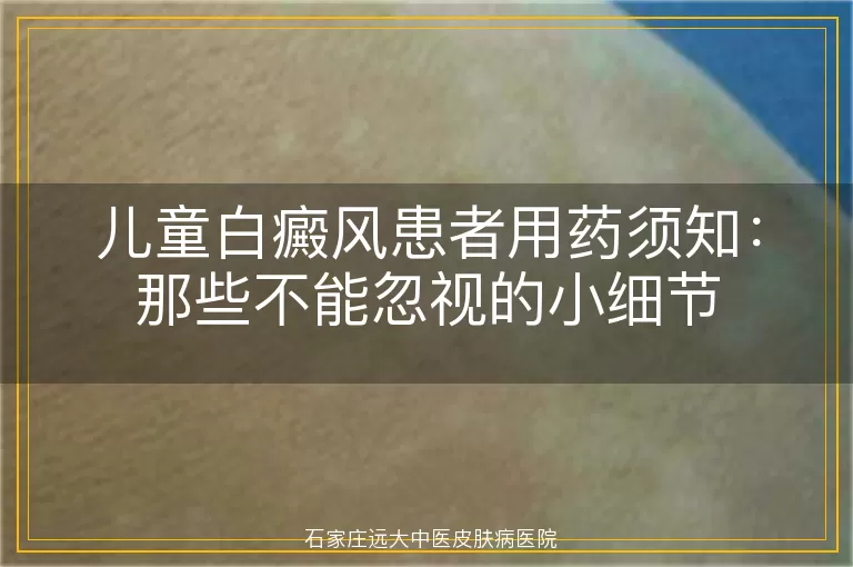 儿童白癜风患者用药须知：那些不能忽视的小细节
