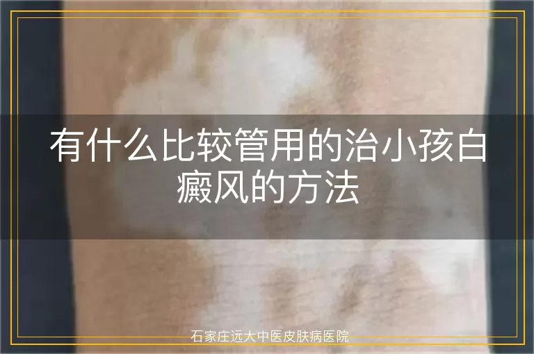 有什么比较管用的治小孩白癜风的方法