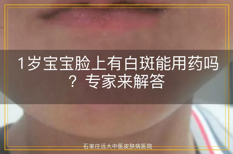 1岁宝宝脸上有白斑能用药吗？专家来解答