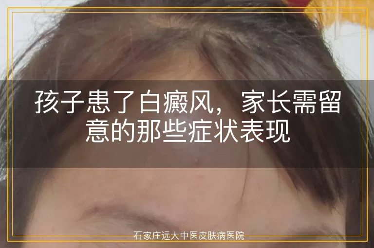 孩子患了白癜风，家长需留意的那些症状表现