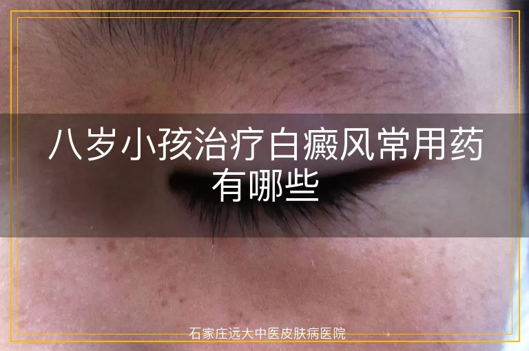 八岁小孩治疗白癜风常用药有哪些