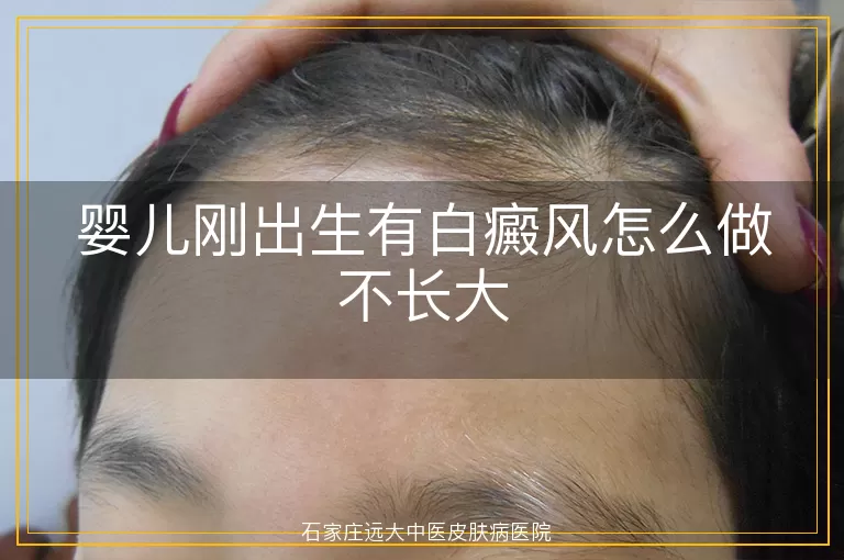 婴儿刚出生有白癜风怎么做不长大