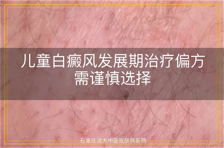儿童白癜风发展期治疗偏方需谨慎选择