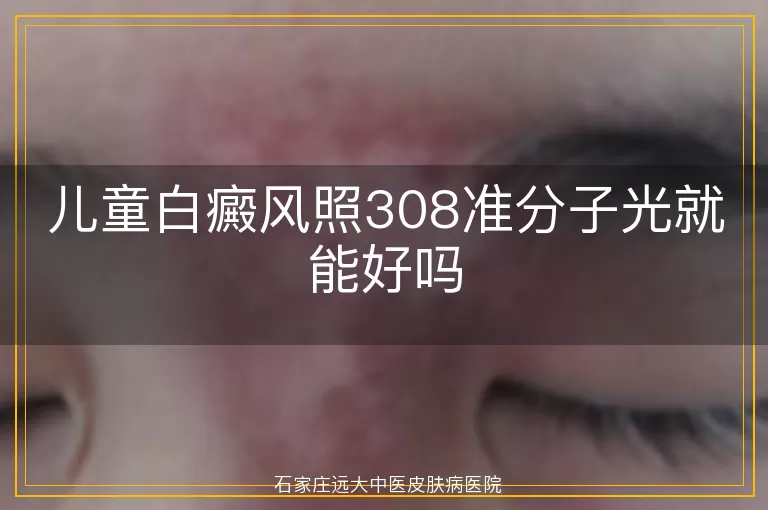 儿童白癜风照308准分子光就能好吗