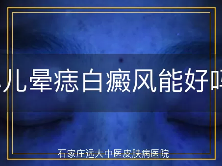小儿晕痣白癜风能好吗？