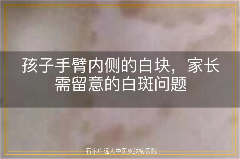 孩子手臂内侧的白块，家长需留意的白斑问题