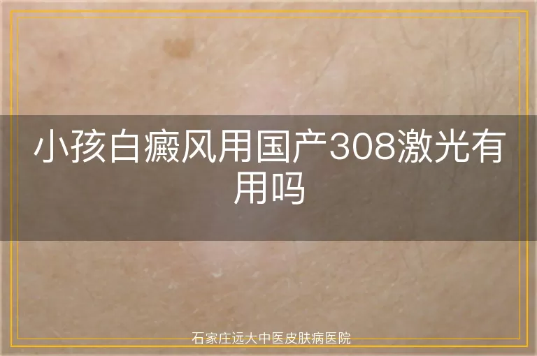 小孩白癜风用国产308激光有用吗