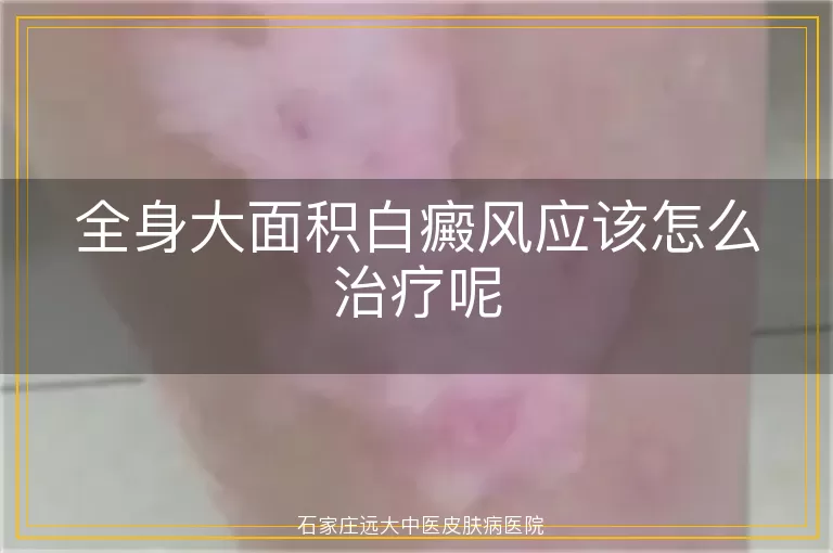 全身大面积白癜风应该怎么治疗呢