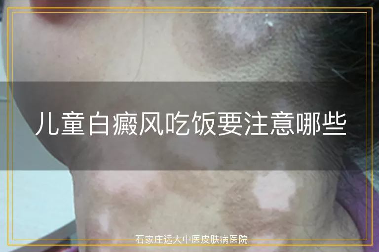 儿童白癜风吃饭要注意哪些