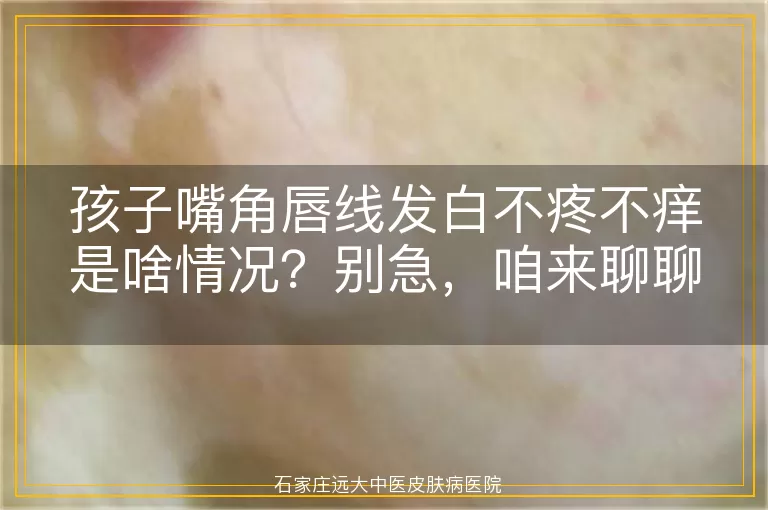 孩子嘴角唇线发白不疼不痒是啥情况？别急，咱来聊聊