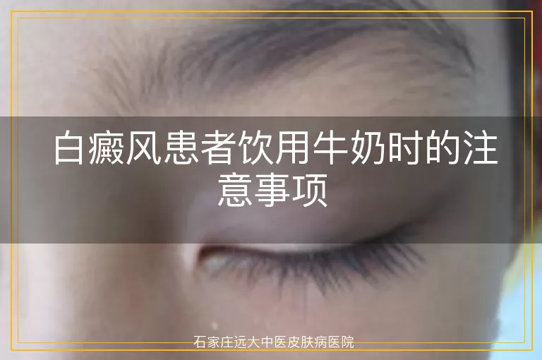 白癜风患者饮用牛奶时的注意事项
