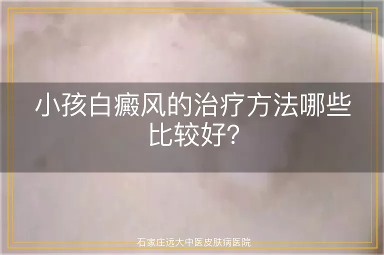 小孩白癜风的治疗方法哪些比较好？