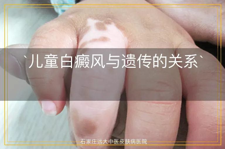 儿童白癜风与遗传的关系