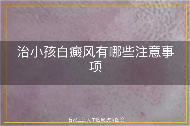 治小孩白癜风有哪些注意事项