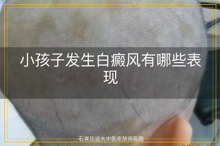 小孩子发生白癜风有哪些表现