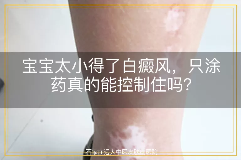 宝宝太小得了白癜风，只涂药真的能控制住吗？