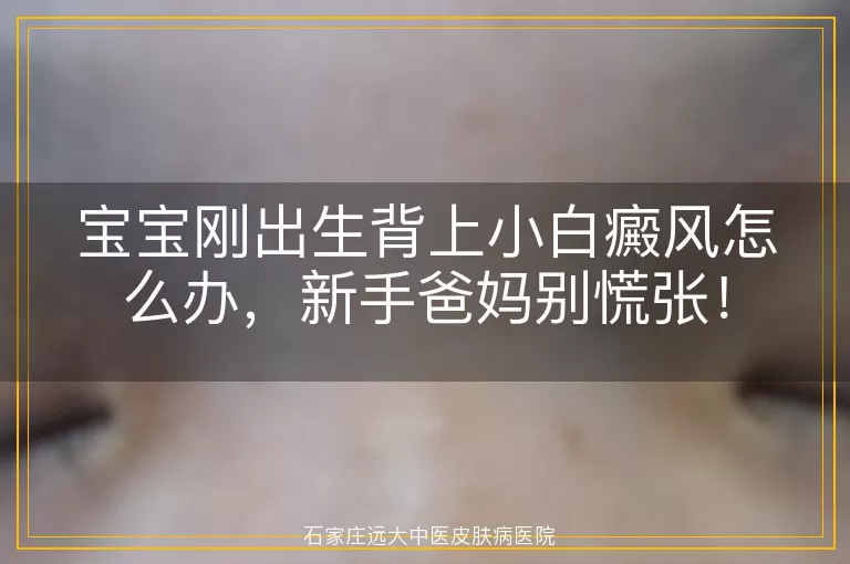 宝宝刚出生背上小白癜风怎么办，新手爸妈别慌张！
