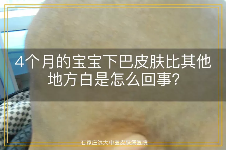 4个月的宝宝下巴皮肤比其他地方白是怎么回事？