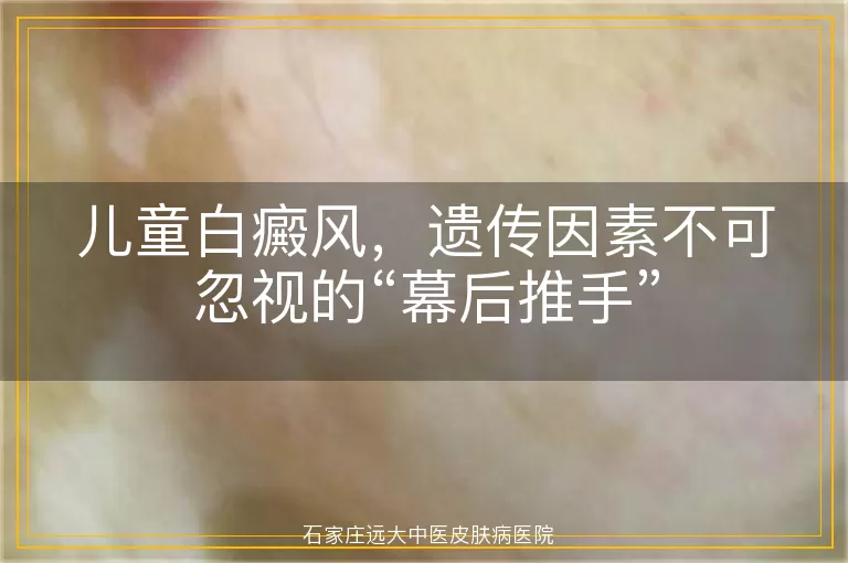 儿童白癜风，遗传因素不可忽视的“幕后推手”