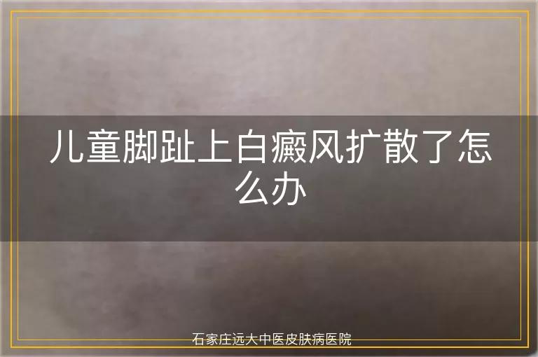 儿童脚趾上白癜风扩散了怎么办