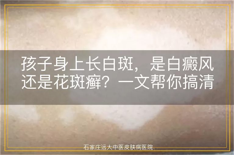 孩子身上长白斑，是白癜风还是花斑癣？一文帮你搞清楚！