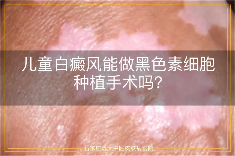 儿童白癜风能做黑色素细胞种植手术吗？