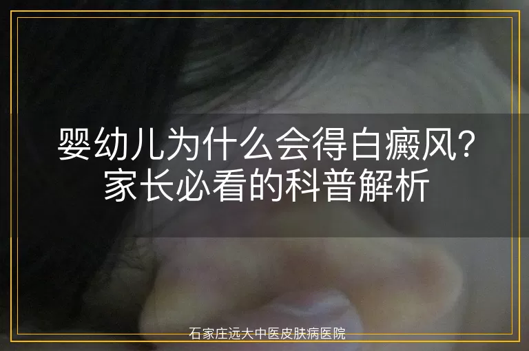 婴幼儿为什么会得白癜风？家长必看的科普解析