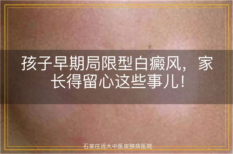 孩子早期局限型白癜风，家长得留心这些事儿！