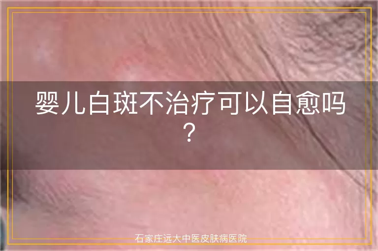 婴儿白斑不治疗可以自愈吗？