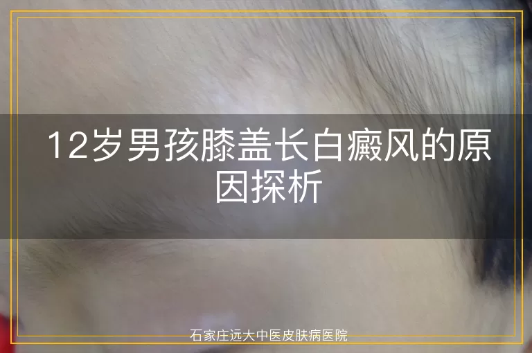 12岁男孩膝盖长白癜风的原因探析
