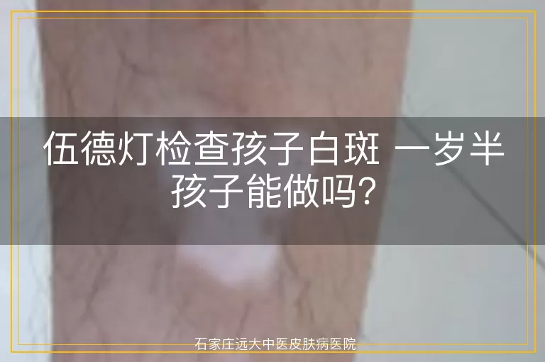 伍德灯检查孩子白斑 一岁半孩子能做吗？
