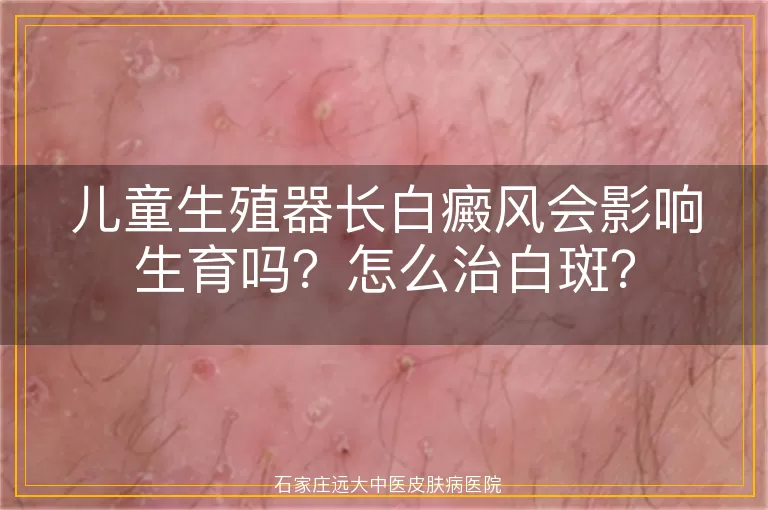 儿童生殖器长白癜风会影响生育吗？怎么治白斑？