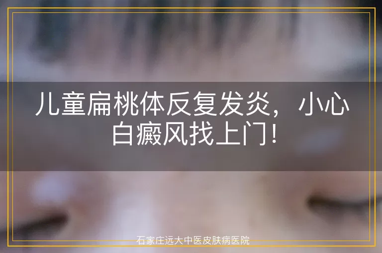 儿童扁桃体反复发炎，小心白癜风找上门！