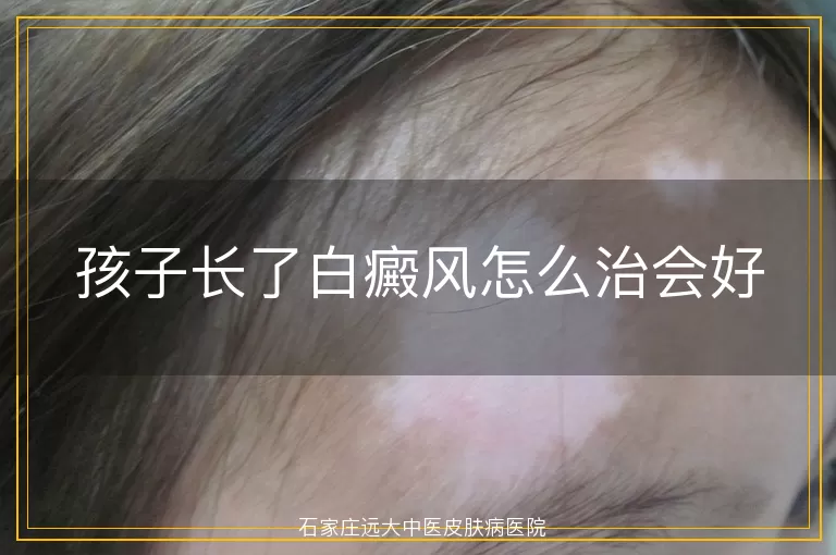孩子长了白癜风怎么治会好