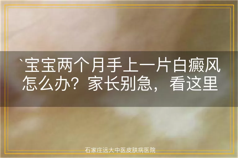 宝宝两个月手上一片白癜风怎么办？家长别急，看这里！